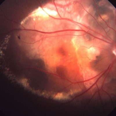 choroidal choroidal